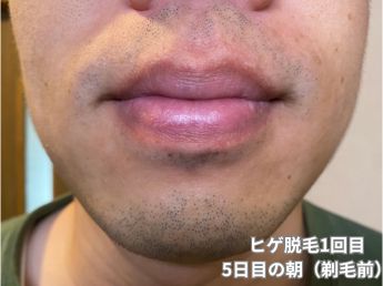 ヒゲ脱毛1回目の5日目の朝（鼻下・アゴ）