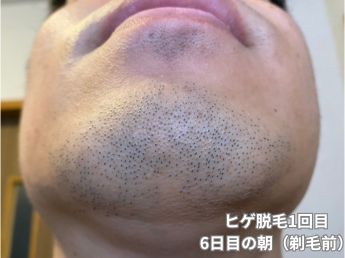 ヒゲ脱毛1回目の6日目の朝（アゴ下）