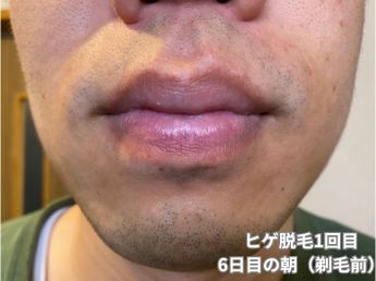 ヒゲ脱毛1回目の6日目の朝（鼻下・アゴ）