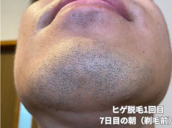 ヒゲ脱毛1回目の7日目の朝（アゴ下）