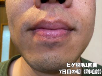 ヒゲ脱毛1回目の7日目の朝（鼻下・アゴ）