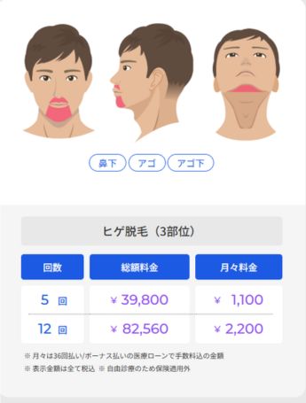 ヒゲ脱毛3部位料金