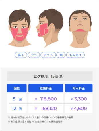 ヒゲ脱毛5部位料金