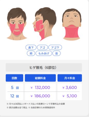 ヒゲ脱毛6部位料金