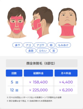 ヒゲ脱毛8部位料金